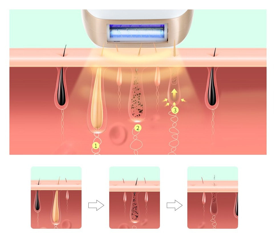 Permanent Hårfjerning Epilator